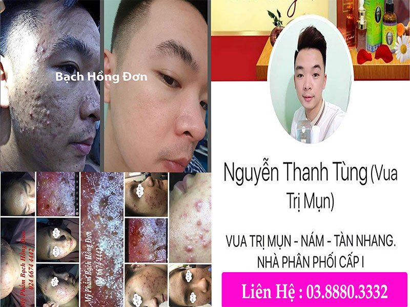 Bạn Nguyễn Thanh Tùng điều trị mụn mủ, sẹo rỗ, thâm mụn,... da sạm, nhiều nhờn dàu, đã bị hơn 10 năm da bị tổn thương,