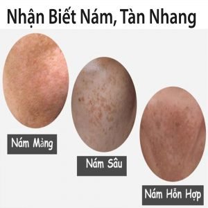 Dinh Nghia Ve Nam Tan Nhang Nguyen Nhan Da Bi Nam Tan Nhang 3791 3