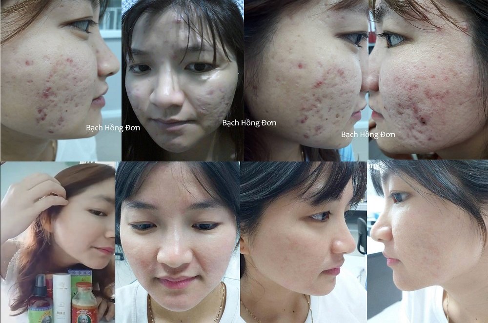 1546535048 Bach Hong Don Dieu Tri Seo Ro Mun Mu Viem
