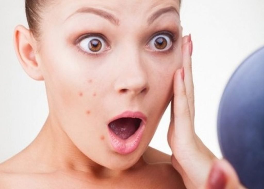Trị Mụn Tuổi Dậy Thì