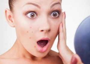 Trị Mụn Tuổi Dậy Thì