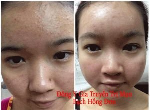 Mặt Nạ – Bạch Hồng Đơn Cao Cấp