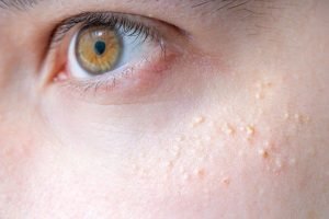 trị mụn trứng cá ở tuổi dậy thì