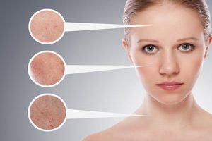 trị mụn tuổi dậy thì
