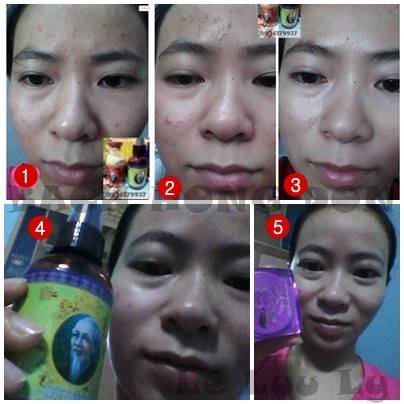 Tổng hợp khách hàng điều trị hiệu quả theo phương pháp đông y gia truyền bạch hồng đơn