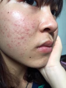Trị Mụn Tuổi Dậy Thì - Em Thủy Học Sinh Cấp 3
