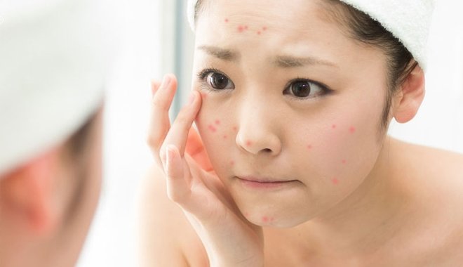 trị mụn tuổi dậy thì