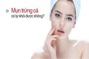 Mun Trung Ca Va Cach Dieu Tri 2