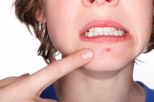 thuốc trị mụn tuổi dậy thì