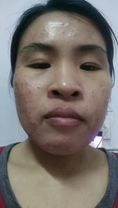 Điều trị mụn mủ viêm, mụn u nang,...Chị Hằng - Bình Dương 6 mụn mủ viêm, mụn u nang 5