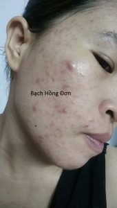 Điều trị mụn mủ viêm, mụn u nang,...Chị Hằng - Bình Dương 9 mụn mủ viêm, mụn u nang 4
