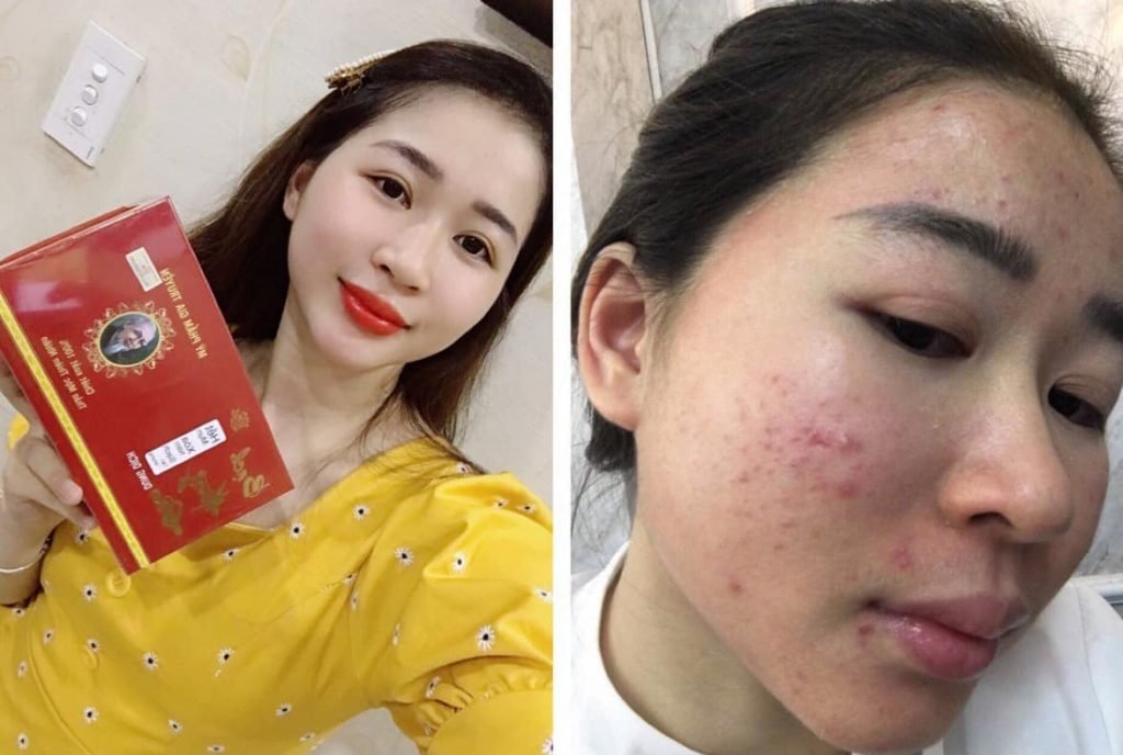 Bạn Hotgirl Tường Vi ở Quảng Ngãi điều trị mụn viêm, mụn ẩn, thâm mụn, rỗ hiệu quả tận gốc 1