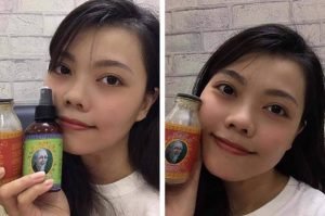 Sản phẩm Diễm dùng điều trị mụn ẩn, mụn viêm, mụn đầu đen, thâm mụn, da sạm, lỗ chân lông to,...