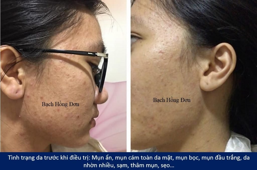 Em sinh viên Nhật Loan điều trị mụn viêm, mụn mủ, mụn đầu đen, mụn ẩn, rỗ, thâm, da sạm... hiệu quả tận gốc 1