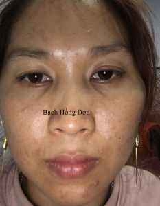 Chị Loan ở Bình Dương điều trị hiệu quả tận gốc mụn viêm, mụn bọc, mụn ẩn, thâm mụn, da không đều màu... lâu năm 9 Da trước điều trị: Nhờn nhiều, da sạm, mụn viêm,mụn bọc, mụn ẩn.
