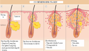 Dinh Nghia Ve Mun Nguyen Nhan Hinh Thanh Mun Nhan Biet Cac Loai Mun 3800