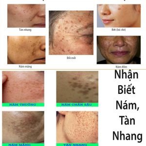 Định nghĩa về Nám, Tàn nhang? Nguyên nhân da bị Nám, Tàn nhang? 4 Định nghĩa về Nám, Tàn nhang? Nguyên nhân da bị Nám, Tàn nhang? 3