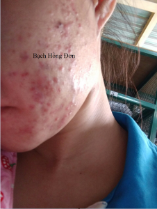 Da trước khi điều trị: Mụn u, mụn viêm, mụn mủ, thâm, rỗ, nhờn nhiều...