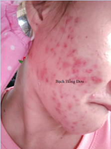 Da trước khi điều trị: Mụn u, mụn viêm, mụn mủ, thâm, rỗ, nhờn nhiều...