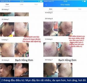 Da có hiện tượng nổi nhiều mụn hơn trong quá trình điều trị Mụn, tốt hay xấu? 2