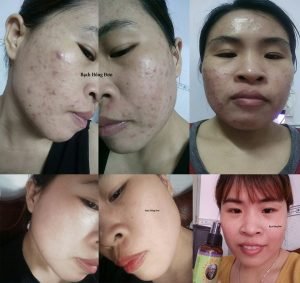 Trị mụn hiệu quả tận gốc