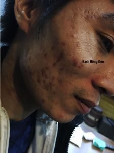 Bạn Đức Tuấn ở Hà Nội điều trị hiệu quả tận gốc mụn u nang, mụn u, viêm, thâm mụn, rỗ... lâu năm 4 Đức Tuấn điều trị hiệu quả Mụn u nang, mụn u, viêm, thâm... Sau 3 năm không tái phát.