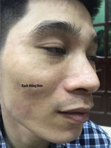 Bạn Đức Tuấn ở Hà Nội điều trị hiệu quả tận gốc mụn u nang, mụn u, viêm, thâm mụn, rỗ... lâu năm 5 Đức Tuấn điều trị hiệu quả Mụn u nang, mụn u, viêm, thâm... Sau 3 năm không tái phát.