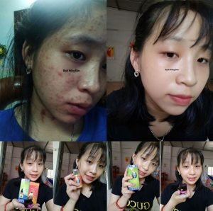 Kỳ Duyên điều trị mụn viêm, mủ, mụn bọc, mụn ẩn, thâm... lâu năm hiệu quả, đã 3 năm không tái phát.