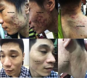 Đức Tuấn điều trị hiệu quả Mụn u nang, mụn u, viêm, thâm... Sau 3 năm không tái phát.
