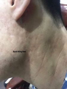 Bạn Đức Tuấn ở Hà Nội điều trị hiệu quả tận gốc mụn u nang, mụn u, viêm, thâm mụn, rỗ... lâu năm 3 Đức Tuấn điều trị hiệu quả Mụn u nang, mụn u, viêm, thâm... Sau 3 năm không tái phát.