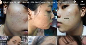Linh Sunty điều trị hiệu quả tận gốc mụn ẩn, thâm, nám, sạm...