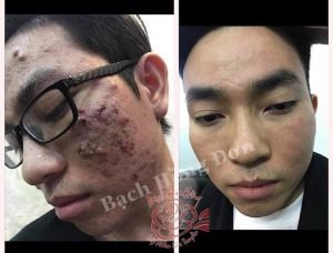 Sai lầm nghiêm trọng và cơ bản nhất khiến tình trạng mụn ngày càng nặng (Nặn mụn,...)