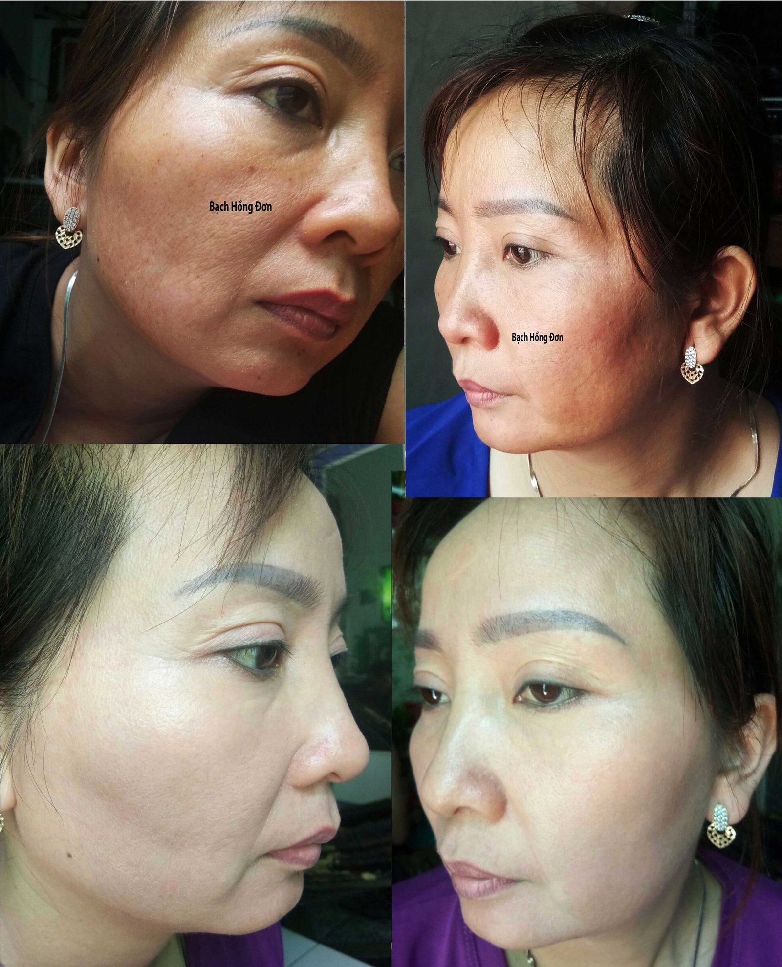 Bạch Hồng đơn Trị Nám Hường đinh